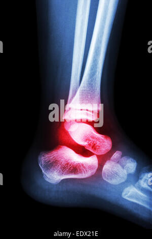 Film x-ray del bambino e della caviglia artrite a caviglia (artrite) Foto Stock