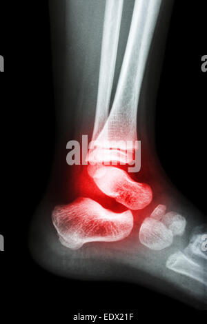 Film x-ray del bambino e della caviglia artrite a caviglia (artrite) Foto Stock