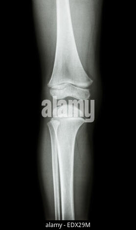 Film x-ray ginocchio ap(antero-posteriore) del bambino Foto Stock