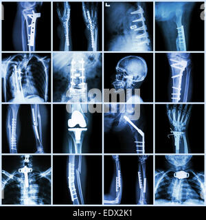 Collezione X-ray chirurgia ortopedica (più parte di umano, operare e per la fissazione interna dalla piastra&vite ) Foto Stock