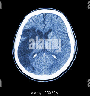 CT Brain : mostra ictus ischemico (hypodensity a destra frontale-lobo parietale) Foto Stock