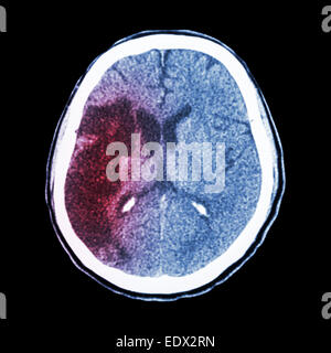 CT Brain : mostra ictus ischemico (hypodensity a destra frontale-lobo parietale) Foto Stock