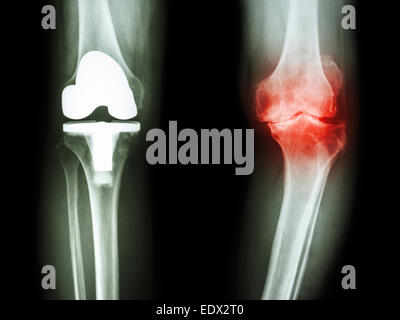 Film x-ray ginocchio osteoartrite del ginocchio del paziente e articolazione artificiale Foto Stock