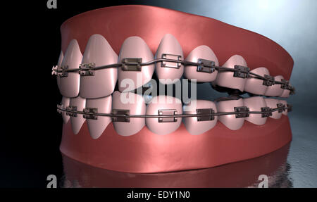 Un sinistro drammatica rappresentazione di seperated superiore e inferiore di gruppi di denti umani con bretelle ad essi applicata al buio su un lugubre spotl Foto Stock