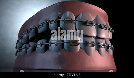 Un sinistro drammatica rappresentazione di seperated superiore e inferiore di gruppi di denti umani con bretelle ad essi applicata al buio su un lugubre spotl Foto Stock