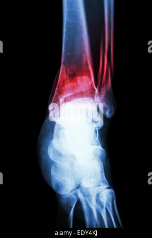 Film x-ray show della caviglia frattura della tibia distale e il perone della gamba (osso) Foto Stock
