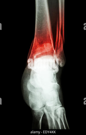 Film x-ray show della caviglia frattura della tibia distale e il perone della gamba (osso) Foto Stock