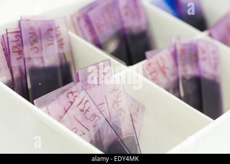 Il sangue periferico cospargere (PBS) sul lato di vetro in ospedale il laboratorio Foto Stock