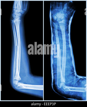 Albero di frattura delle ossa ulnare ( avambraccio osso ) : ( a sinistra : pre-trattamento , destra : psot-trattamento (stecca con cast) ) Foto Stock