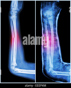 Albero di frattura delle ossa ulnare ( avambraccio osso ) : ( a sinistra : pre-trattamento , destra : psot-trattamento (stecca con cast) ) Foto Stock
