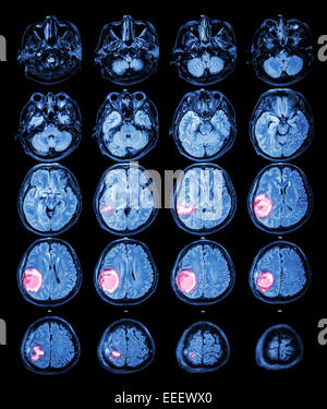 MRI brain : tumore al cervello a destra lobo parietale Foto Stock