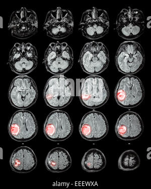 MRI brain : tumore al cervello a destra lobo parietale Foto Stock