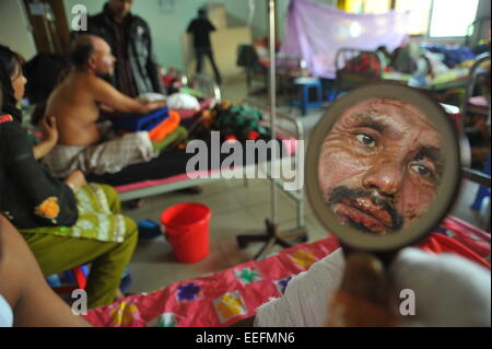 Dacca in Bangladesh. Xvii gen, 2015. Amulla Barmon guardando la sua faccia nello specchio di Dhaka Medical Hospital. Egli è stato bruciato in un bus lo scorso 11 Gennaio presso Farmget a Dhaka. Il 35 percento del suo corpo è bruciato. Almeno 12 vittime sono stati ammessi per l'unità di masterizzazione di Dhaka Medical Hospital negli ultimi 14 giorni di violenza politica. Essi sono stati attaccati e bruciati in una violenta protesta politica. Credito: Mamunur Rashid/Alamy Live News Foto Stock