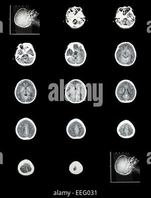 Scansione TC (tomografia computerizzata) di cervello normale ( sistema cerebrovascolare ) Foto Stock