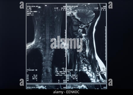 Raggi X la colonna vertebrale e collo radiografia Foto Stock