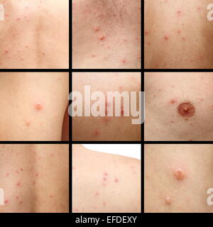 Dettagli della varicella macchie sulla pelle umana Foto Stock