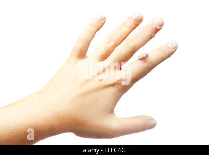 Mano con verruche isolati su sfondo bianco Foto Stock