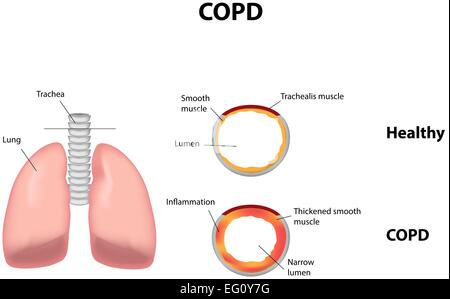 COPD Malattia polmonare cronica ostruttiva Illustrazione Vettoriale