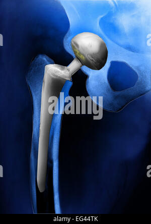 Protesi dell'anca, endoprotesi d'anca, anca, X-ray Foto Stock