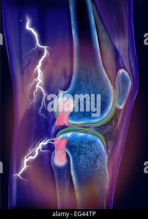 Ginocchio genere Articulatio, laterale legamento collaterale pregiudizio, area di dolore, tomografia computerizzata Foto Stock