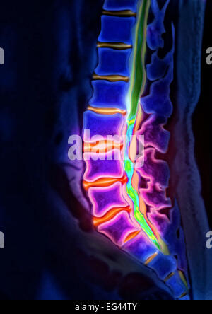 Ernia del disco, vertebra lombare, tomografia computerizzata Foto Stock