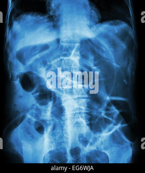 Occlusione intestinale ( X-ray addome posizione supina : il grosso intestino si dilatano a causa di intestino crasso ostruzione a causa di cancro al colon) Foto Stock