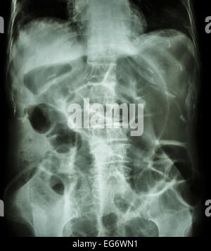 Occlusione intestinale ( X-ray addome posizione supina : il grosso intestino si dilatano a causa di intestino crasso ostruzione a causa di cancro al colon) Foto Stock
