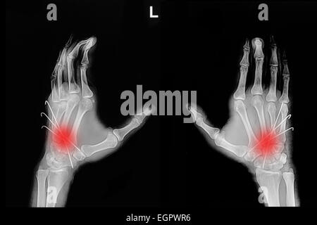 Film x-ray di mano frattura : mostra la frattura ossa metacarpali inserto con k-filo (filo di Kirschner) Foto Stock