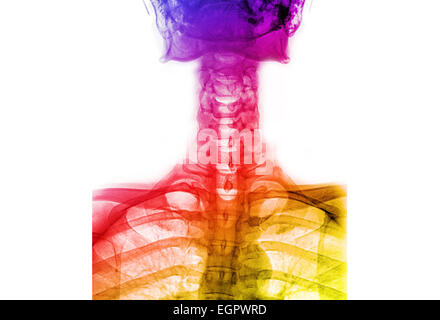 Colorata x-ray T-L(rachide dorso Thoracic-Lumbar) Foto Stock