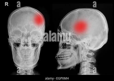 X-ray foto del cranio del pregiudizio Foto Stock