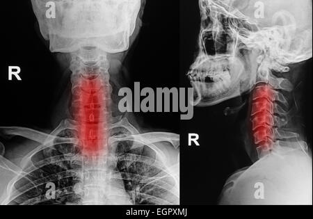 Immagine a raggi x della colonna cervicale, collo immagine a raggi x Foto Stock