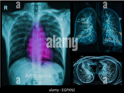 Radiografia Torace sotto immagine 3d ,polmoni immagine 3D Foto Stock