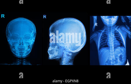 Raccolta dei bambini i raggi x mostrano immagini cranio e immagine del torace Foto Stock