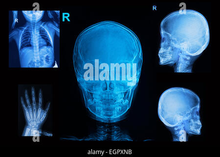 Raccolta dei bambini i raggi x mostrano immagini cranio il torace e l'immagine della mano Foto Stock