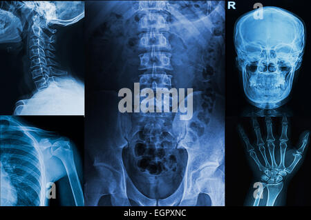 Collezione raggi x immagine dell uomo ,mostrano l'estremità superiore della parte di corpo di umana Foto Stock