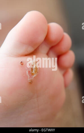 Verruca verruca plantare su un bambino il piede. Foto Stock