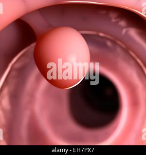 Polipo al colon umano, illustrazione Foto Stock