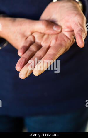 Donna di mano di una sindrome di Raynaud suffere. Foto Stock