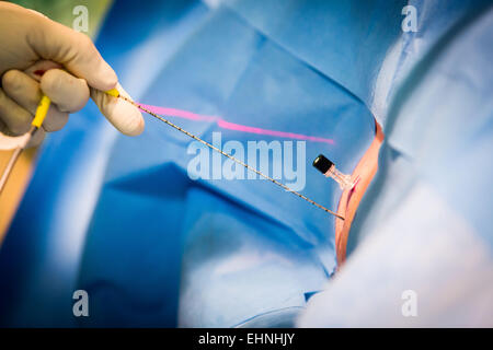 CT scan-assisted crioterapia per distruggere un tumore renale, Saint-Louis ospedale, Paris, Francia. Foto Stock