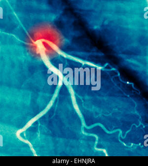 Angiogramma coronarico arteria affetta da stenosi. Foto Stock