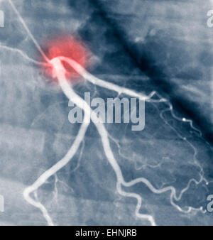 Angiogramma coronarico arteria affetta da stenosi. Foto Stock