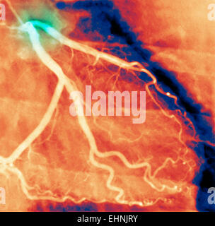 Angiogramma coronarico arteria affetta da stenosi. Foto Stock