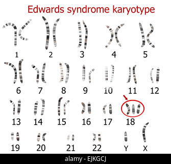 Cariotipo sindrome di Edward - trisomia 18 Foto Stock