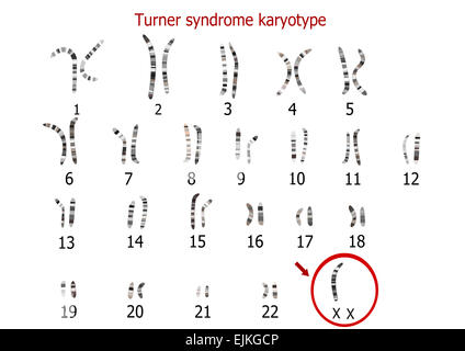 Sindrome di Turner cariotipo Foto Stock