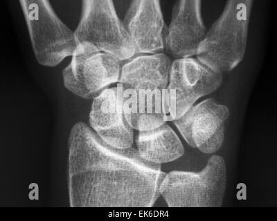 X-Ray del Carpal e ossa metacarpali in mano umana Foto Stock