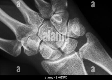 X-Ray del Carpal e ossa metacarpali in mano umana Foto Stock