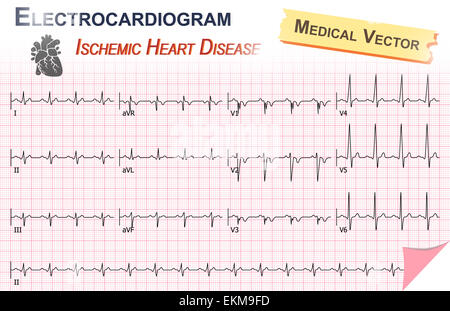 Elettrocardiogramma ( ECG , EKG ) di malattie ischemiche del cuore ( Infarto miocardico ) e anatomia di Icona cuore Foto Stock