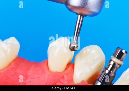 Trapano e impianto dentale nella ganascia, close up Foto Stock