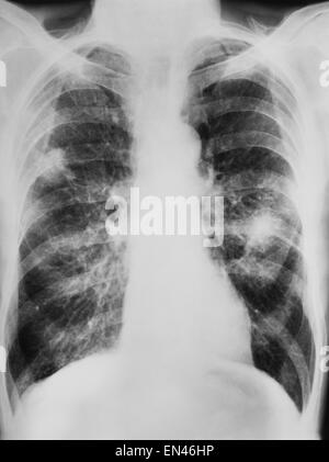 X-ray ombra sul polmone fumatore motore categoria b il cancro del polmone umano torace toracica Foto Stock