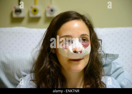 Giovane donna con bende sul viso mentre il recupero da un naso lavoro (rinoplastica) su un letto di ospedale Foto Stock